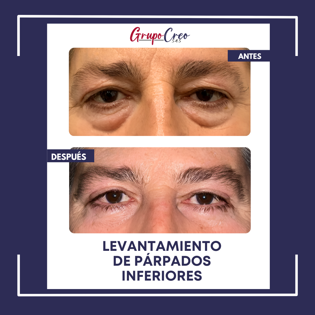 Eliminación de bolsas en párpados