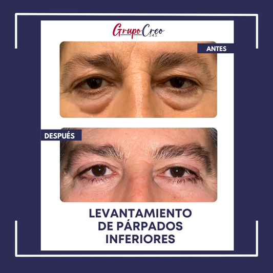 Eliminación de bolsas en párpados
