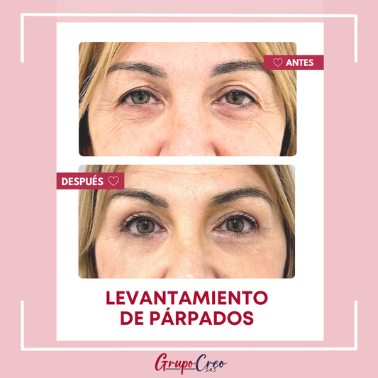 Levantamiento de párpados superiores